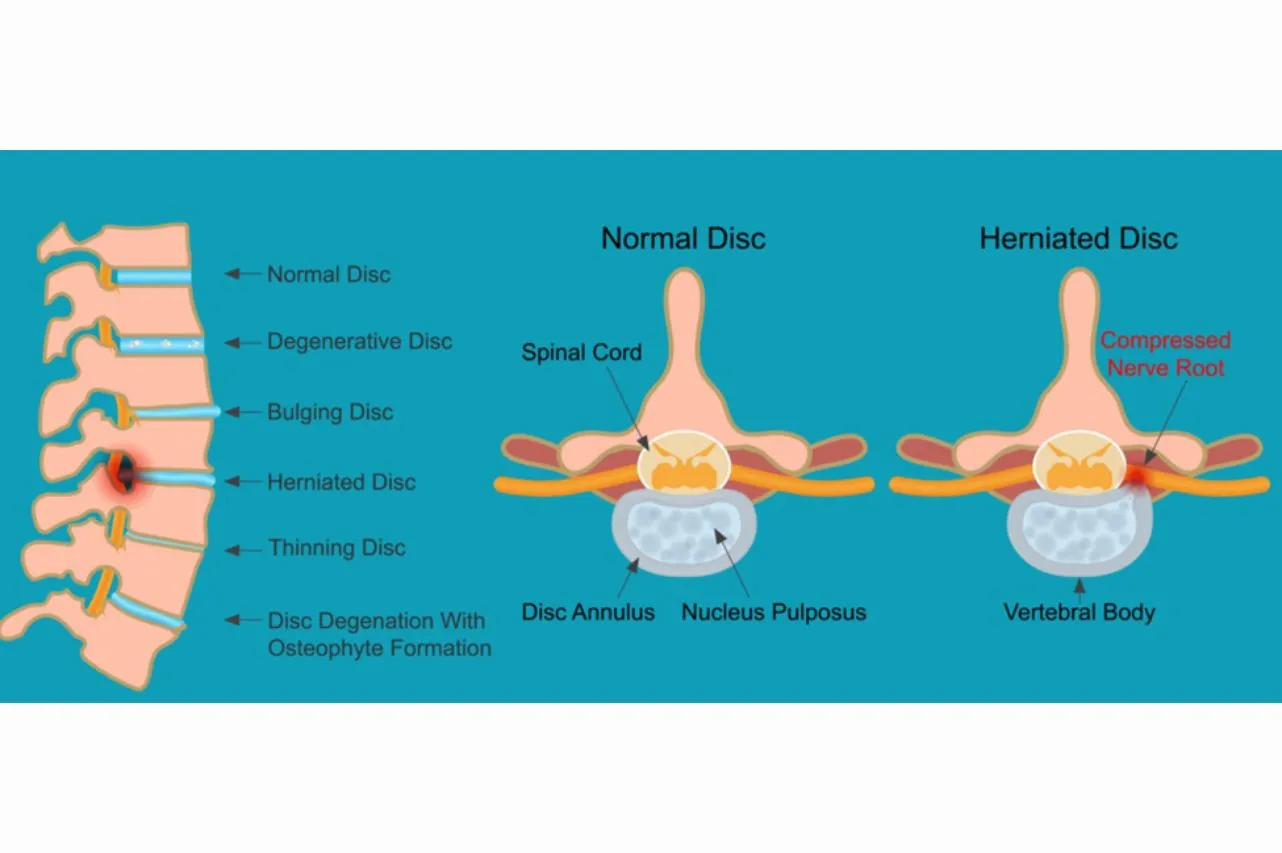 Cervical & Lumbar Traction อาการปวดคอ ปวดหลัง หรือปวดร้าวลงแขน–ขา เป็นปัญหาที่พบได้บ่อย โดยเฉพาะในคนวัยทำงานและผู้สูงวัย หนึ่งในวิธีที่หลายคนเคยได้ยินคือ “การดึงคอ–ดึงหลัง” หรือที่เรียกว่า