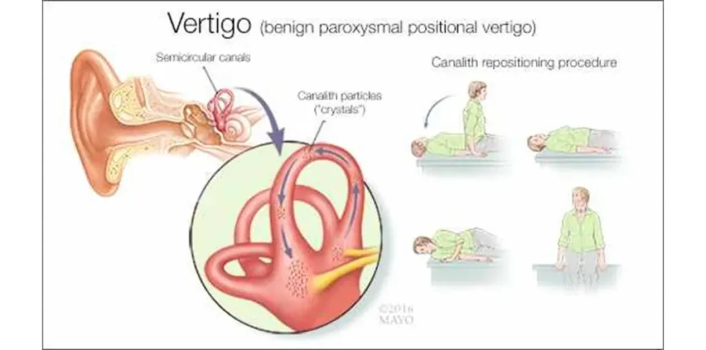 ความผิดปกติของหูชั้นใน (เช่น BPPV หรือที่เรียกกันว่าหินปูนหลุด)