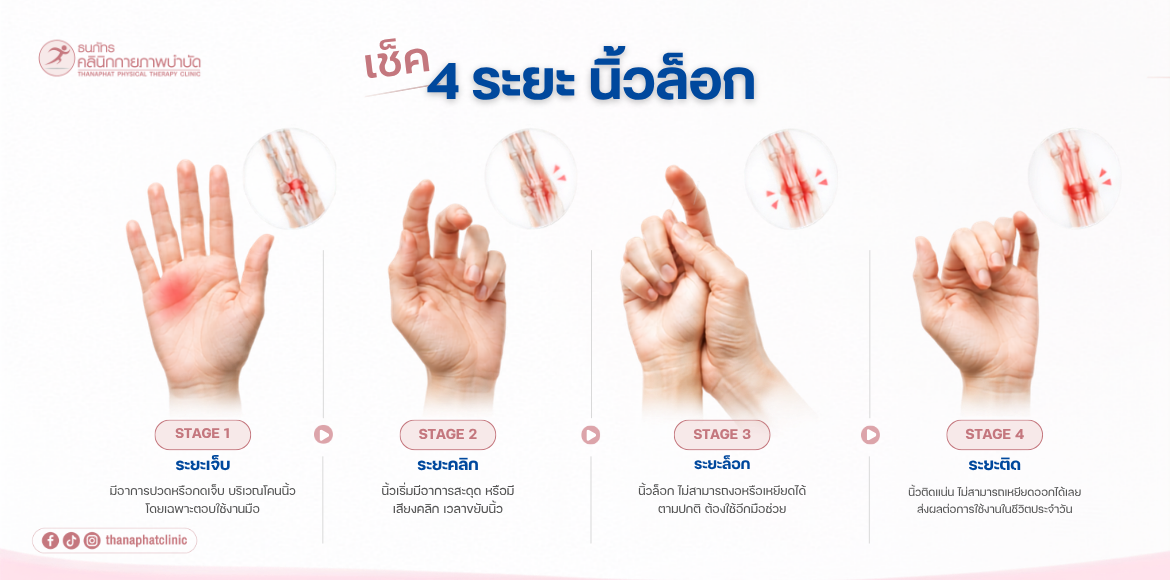 4 ระยะ นิ้วล็อก 4 ระยะ นิ้วล็อก